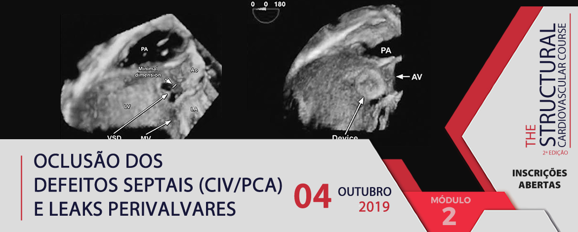 Oclusão dos Defeitos Septais (CIV/PCA) e Leaks Perivalvares