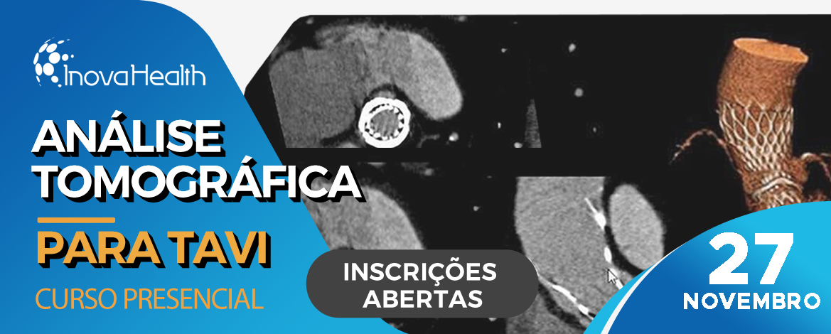 Análise Tomográfica para TAVI
